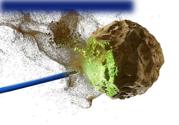 Laser Kidney Stone Treatment